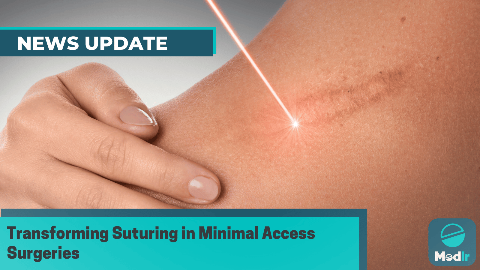 Transforming Suturing in Minimal Access Surgeries