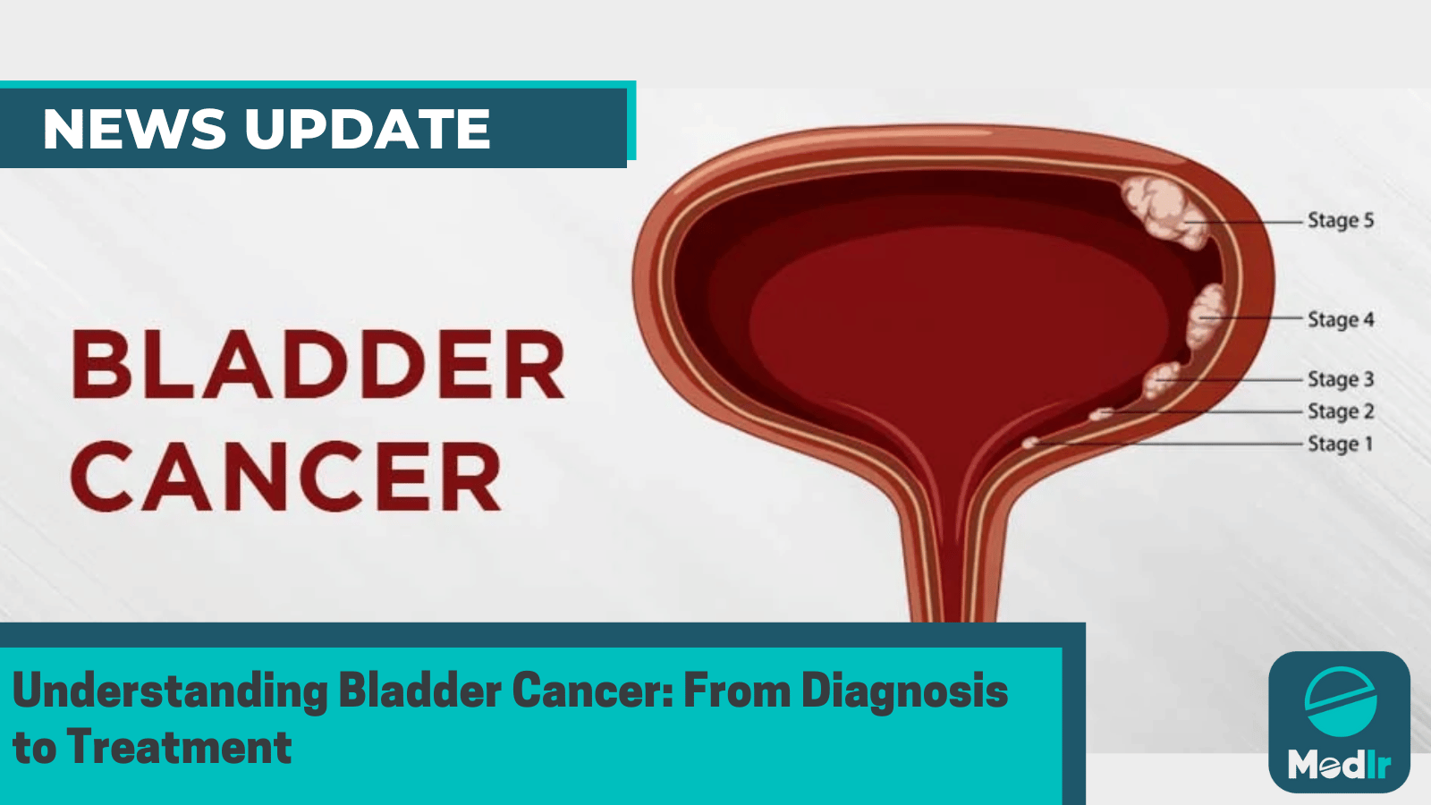 Understanding Bladder Cancer: From Diagnosis to Treatment