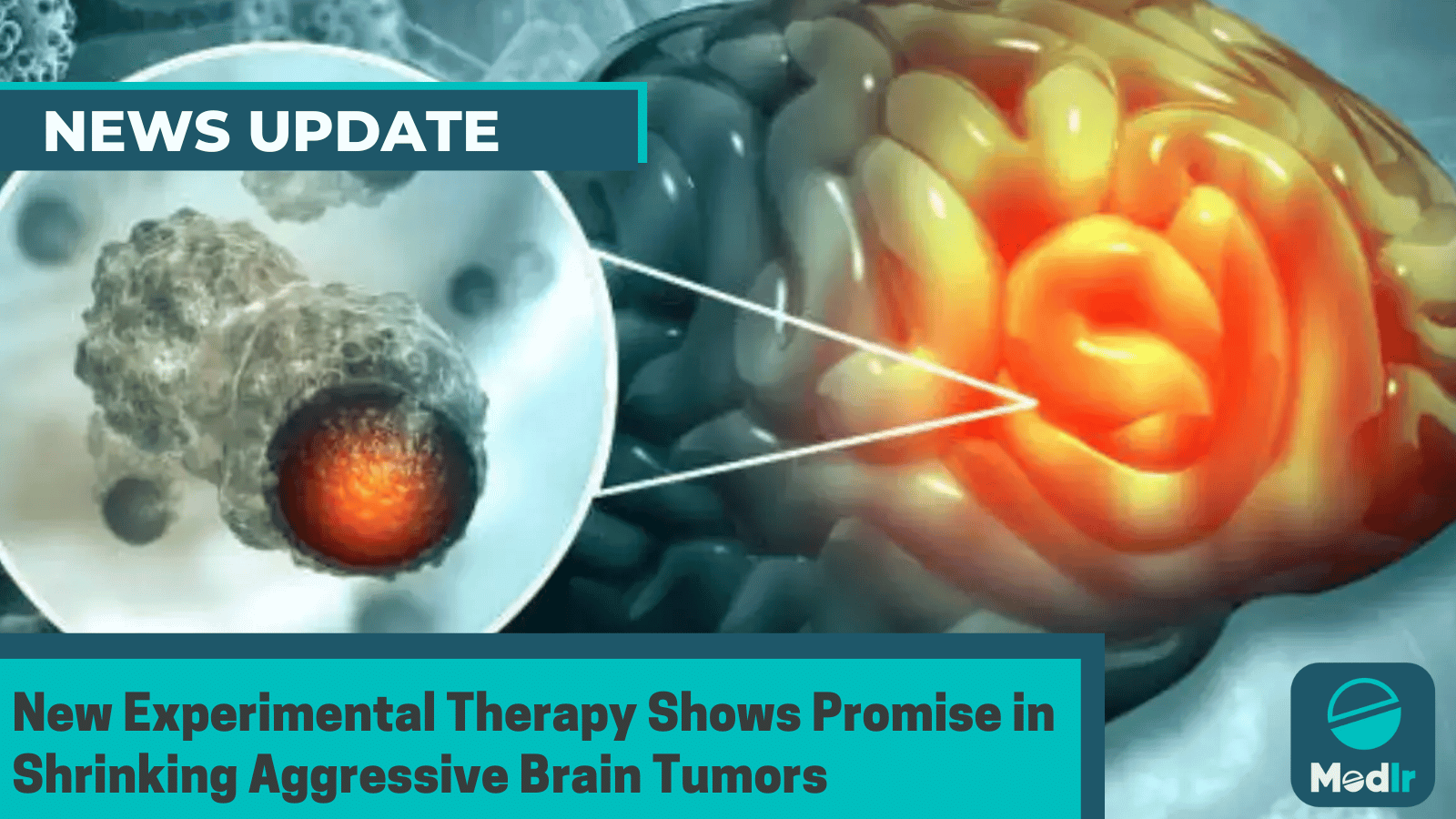 New Experimental Therapy Shows Promise in Shrinking Aggressive Brain Tumors